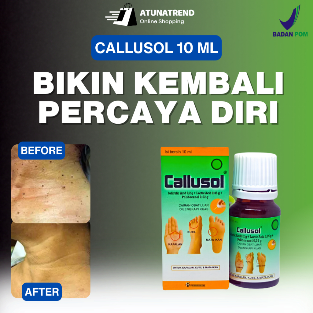 Callusol Obat Kutil Paling Ampuh Obat Mata Ikan Plester Kutil Hansaplast Mata Ikan di Kaki
