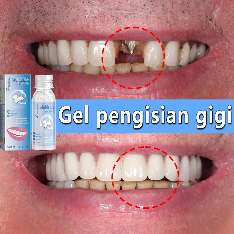 Penambal gigi berlubang lem gigi palsu permanen lem gigi butiran penambal gigi tahan panas tambal gi