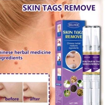 Eelhoe penghilang kutil dan tahi lalat