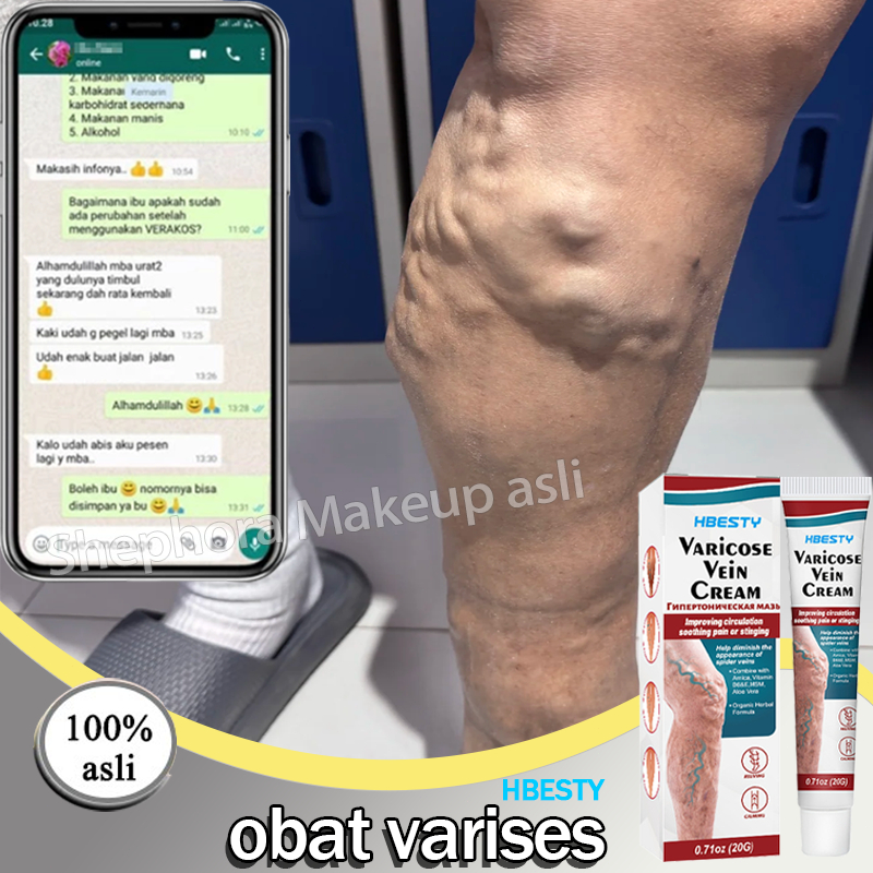 Varises original obat parises kaki paling ampuh salep varises 20g salep laba-laba Pengobatan Vaskuli