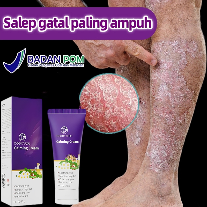 Salep eksim salep gatal obat eksim salap gatal 20g eksim paling ampuh obat gatal selangkangan Obat G