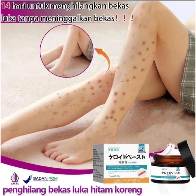 CREAM PENGHILANG BEKAS LUKA HITAM KORENG BUDUKAN PALING AMPUH KULIT KAKI TANGAN TUBUH BADAN WAJAH SA