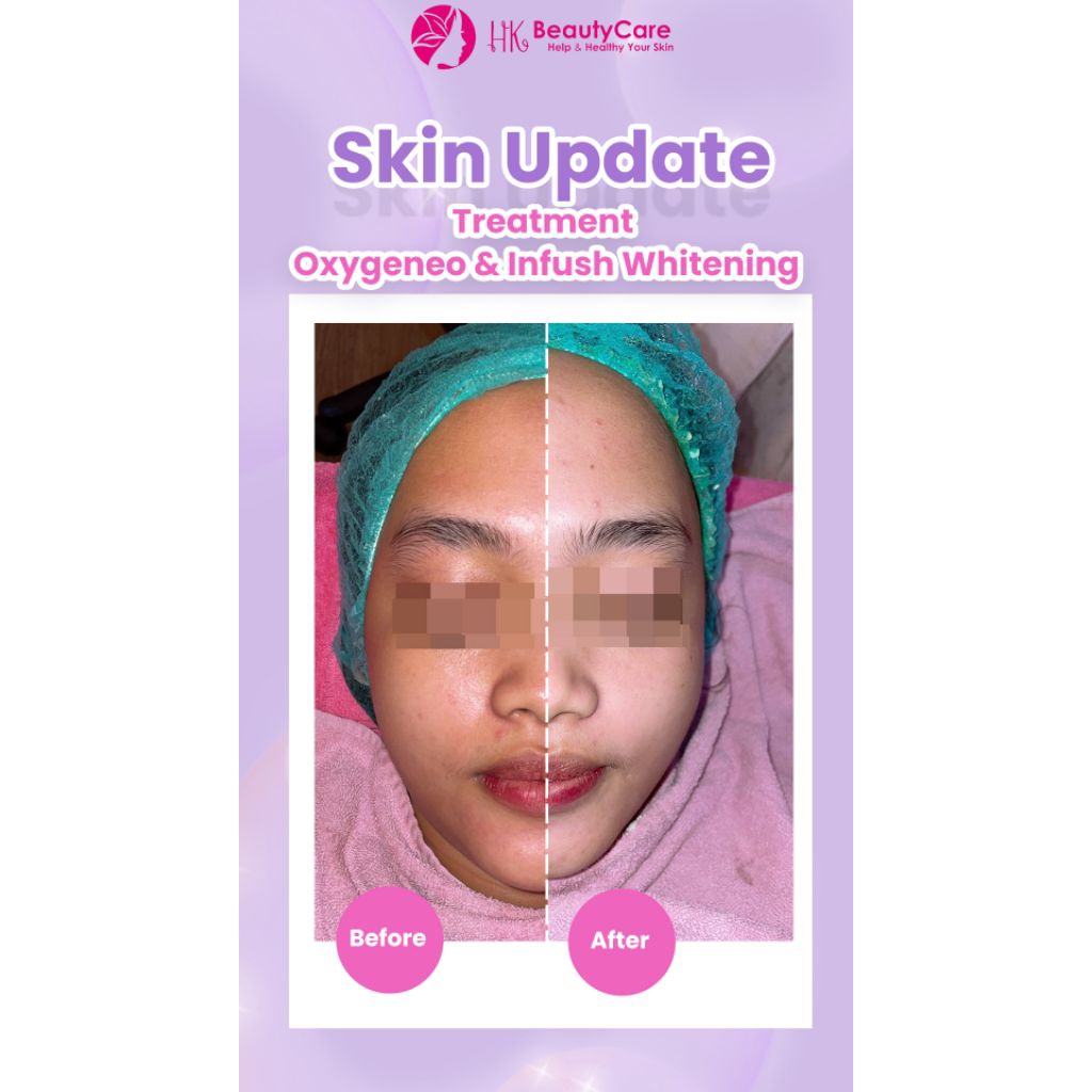 Treatment HK Beautycare - Infus whitening