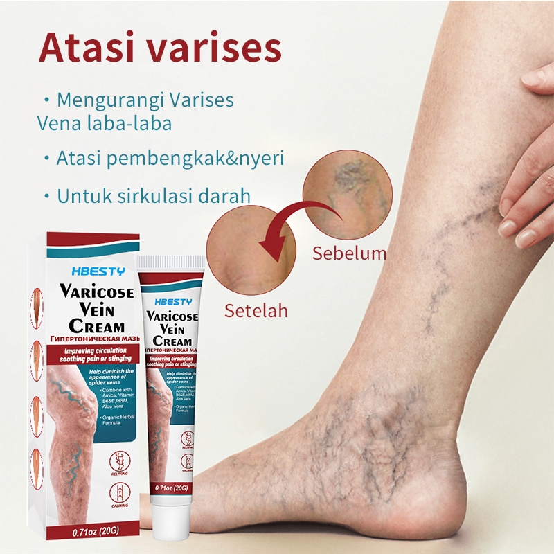 Obat varises salep varises paling ampuh salep varises obat varises kaki 20g cream varises paling amp