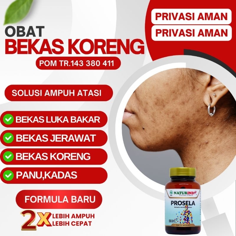 Obat Bekas Koreng Luka Bakar Luka Koreng Gudikan Herbal