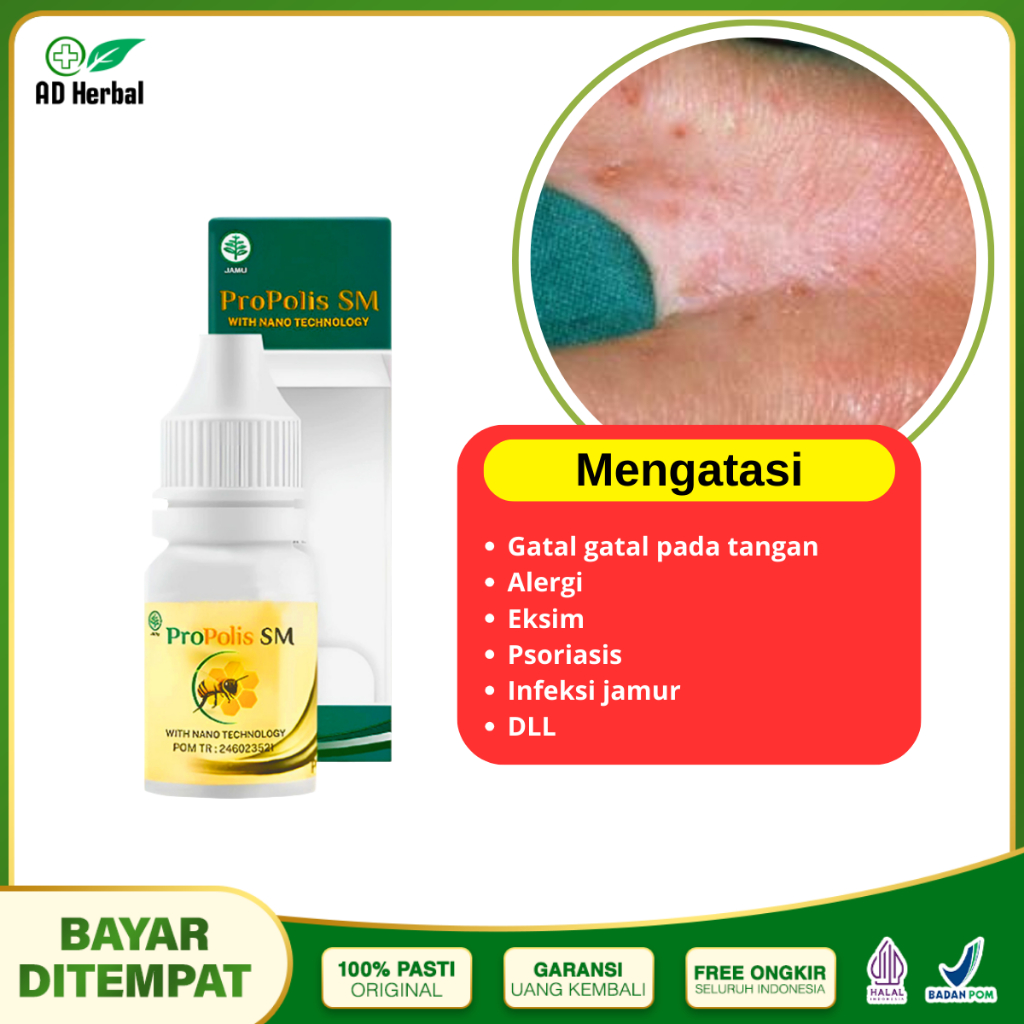 Obat Alergi Gatal Gatal, Jari, Kaki, Tubuh, Kulit Gatal,obat gatal di tanagn Propolis SM
