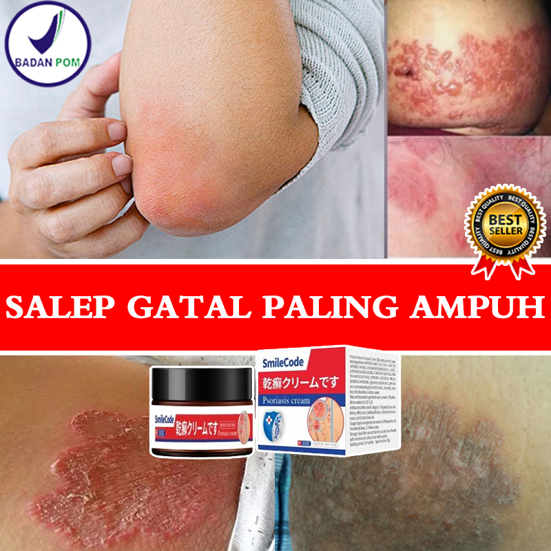 Salep gatal paling ampuh Obat gatal selangkangan 30g Salep gatal selangkanganSalep gatal pada miss v