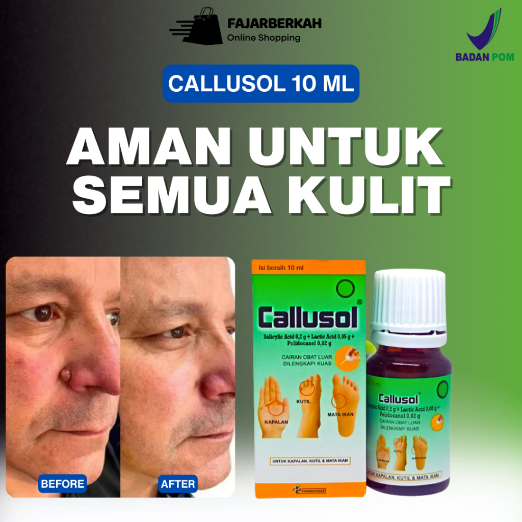 Callusol Salep Kutil Paling Ampuh Plester Mata Ikan Hansaplast Kutil Obat Kutil di Kaki Tangan