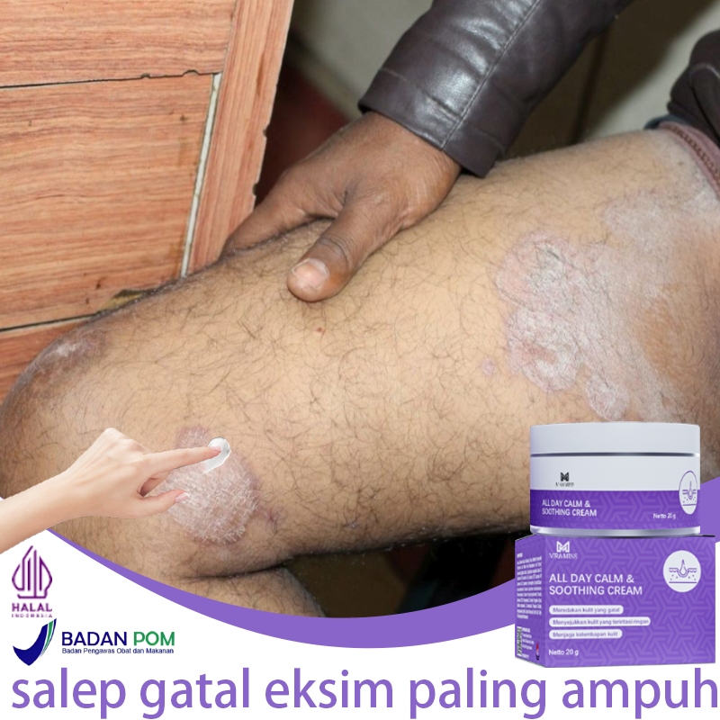 Salep gatal china paling ampuh obat gatal selangkangan salep eksim paling ampuh 20g salep gatal eksi