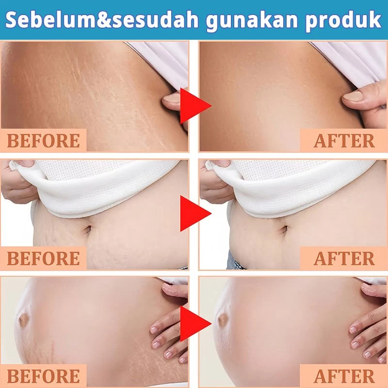 100% OriKrim Stretch Mark Stretch Mark Cream Penghilang Stretch Mark 120G Krim Penghilang Strechmark