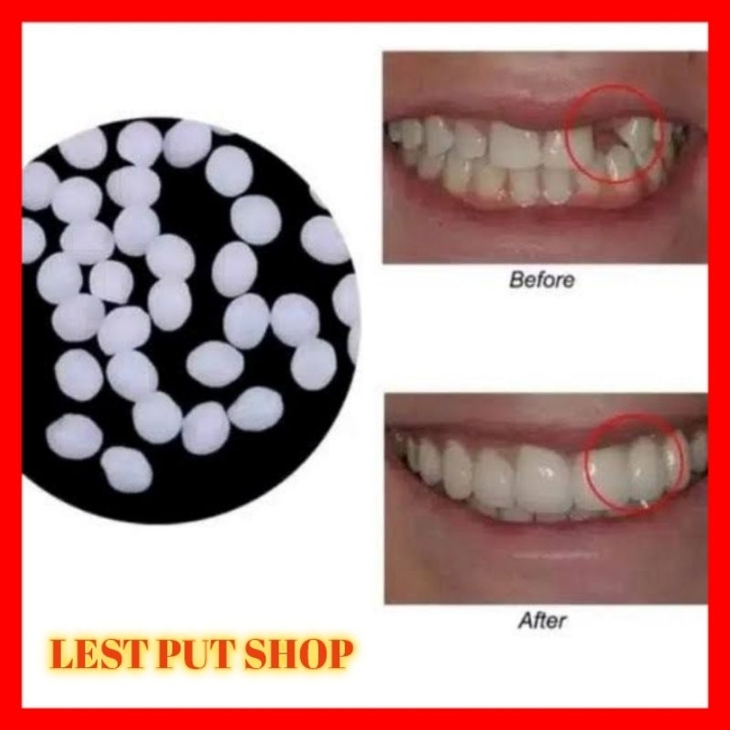 penambal gigi ompong