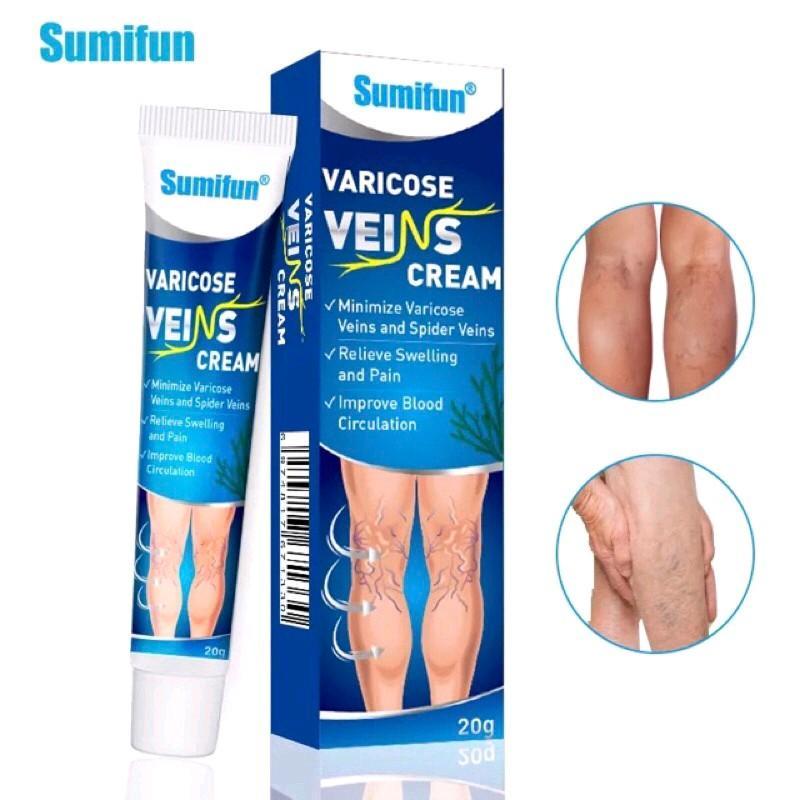 VARICOSE VEINS CREAM mengatasi varises Kaki Tubuh saleb varises