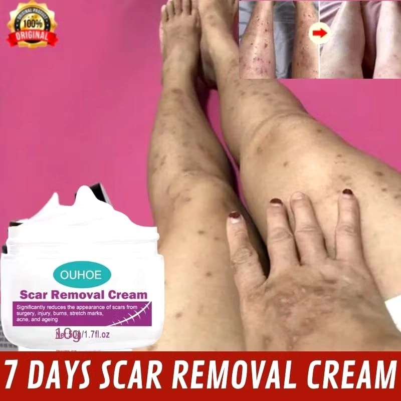 MORYMONY - Scar Remover Cream Penghilang Bekas Luka Koreng