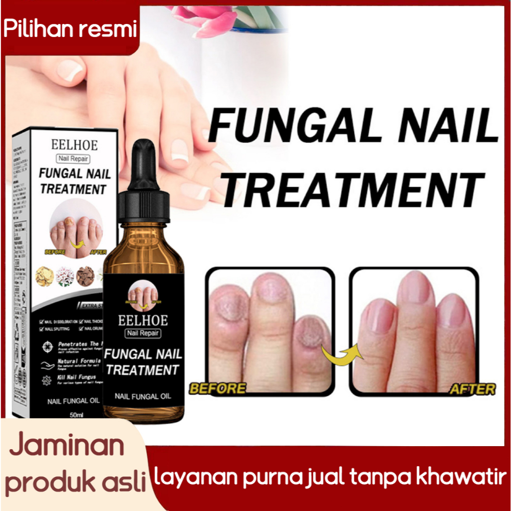 Obat Jamur Kuku Perawatan Kuku Obat Kuku Jamur dan Rusak Penghilang Jamur Kuku Obat Infeksi Kuku Nai