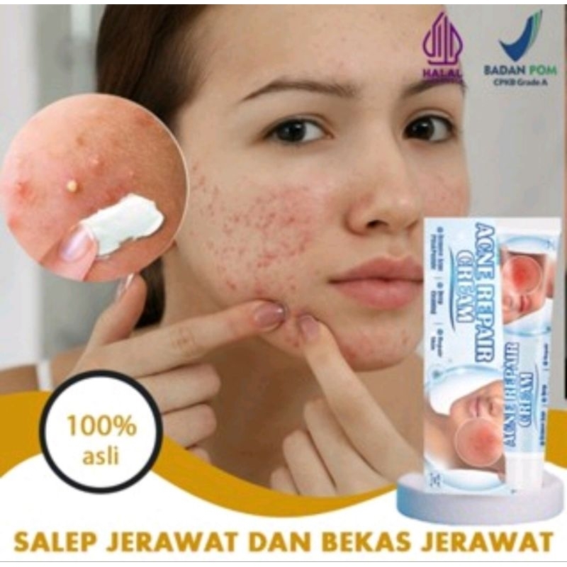 cream jerawat//salep penghilang jerawat dan bekas jerawat