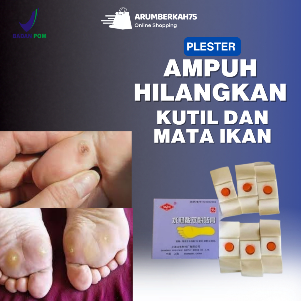 Obat Kutil Plester Mata Ikan Hansaplast Paling Ampuh untuk Telapak Kaki dan Tangan Terbukti