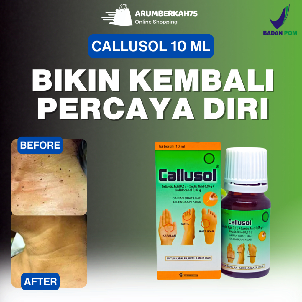 Callusol Obat Kutil Paling Ampuh Obat Mata Ikan Plester Kutil Hansaplast Mata Ikan di Kaki