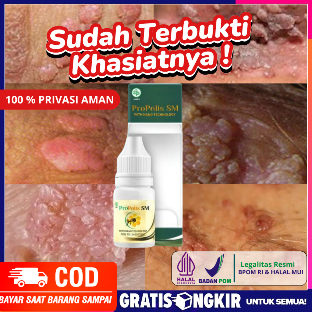 Propolis SM - Obat Kutil Kelamin Pria dan Wanita, Hpv, Gatal Kemaluan, Sifilis, Kutil Dianus, Kencin