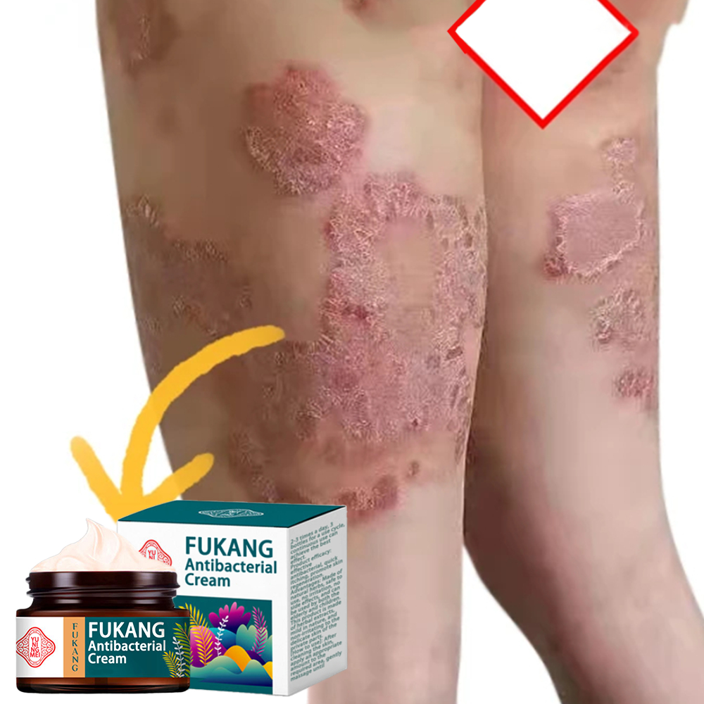 salep gatal paling ampuh salep eksim kering Ruam Dermatitis obat gatal selangkangan  psoriasis obat 