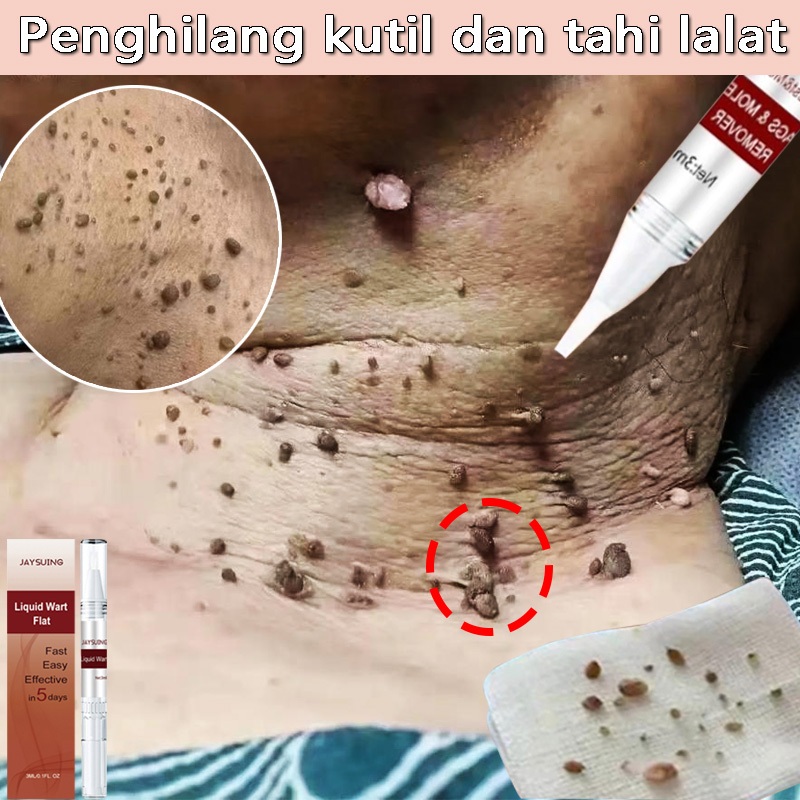Penghilang kutil dan tahi lalat salep kutil paling ampuh skin tag remover kutilos untuk wajah dan le