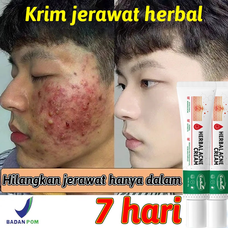 【BPOM】CINSULIN Salep Acnes Penghilang Jerawat dan Bekas Jerawat – Obat Totol Jerawat Herbal, Mengura