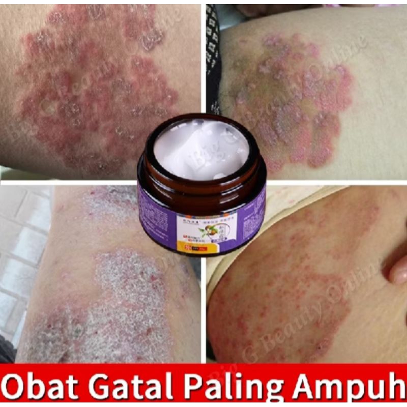 Menghilangkan Eksim Kurap Psoriasis Cream Obat Gatal Bokong Dan Selangkangan Obat Gatal Seluruh Bada