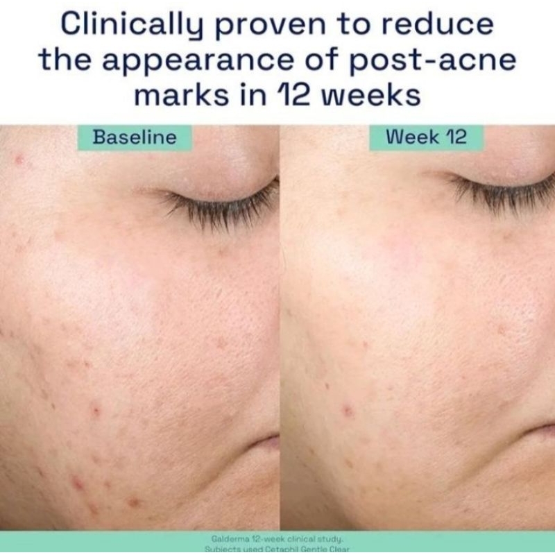 Cetaphil Gentle Clear Repairing Post Acne Serum 30ml