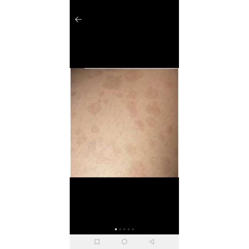 SALEP ANTI JAMUR PANU HITAM/ PUTIH basmi  flek hitam AMPUH