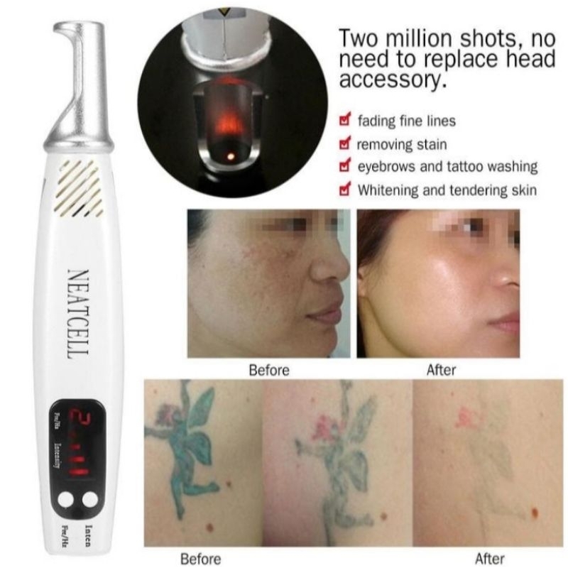 penghilang tato Neatcel laser merah