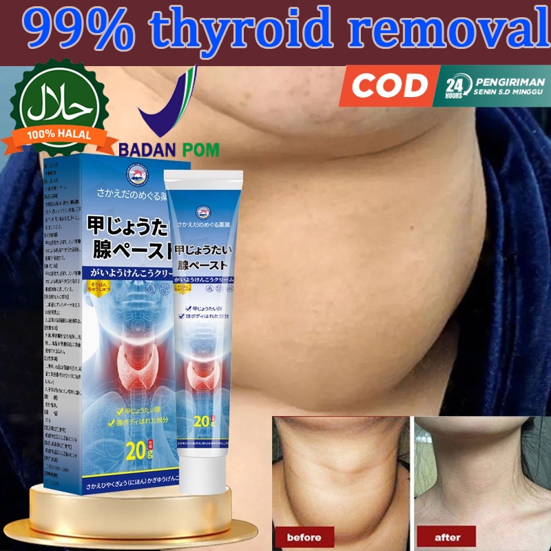 Krim tiroid, obat gondok, benjolan di leher, gondok toksik, kista tiroid, bekerja cepat, menghilangk