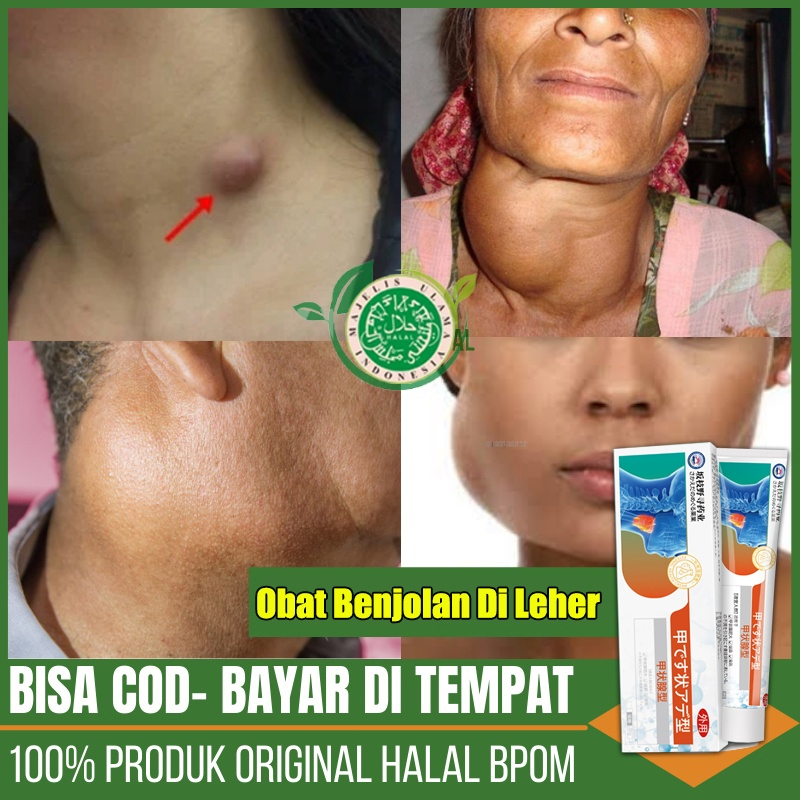 Obat Benjolan Krim Tiroid Obat Gondok Kelenjar Tiroid 20g Obat Benjolan Di Leher Mengurangi Pembengk