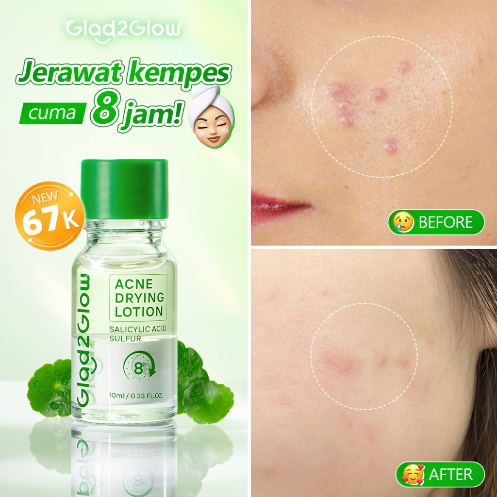 [100% ORI]GLAD2GLOW Acne Drying Lotion - Totol Jerawat Ampuh Malam Hari, Kandungan Aktif: Niacinamid