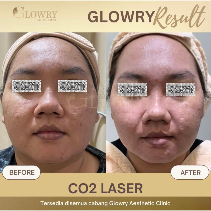 GLOWRY || LASER FRACTIONAL CO2 || PICO LASER || ANTI BOPENG