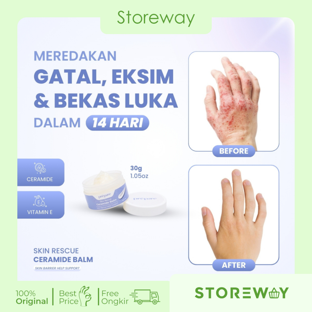 Prepare Ezema Cream Pelembab Kulit Kering Tangan Kaki Obat Gatal Jerawat Punggung Dan Bekasnya