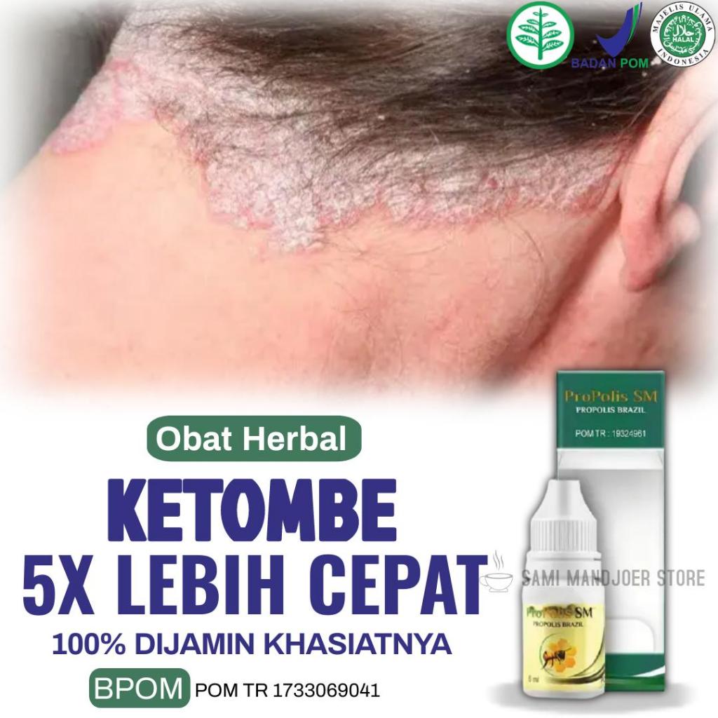 Propolis SM - Obat Ketombe Berkerak, Ketombe Kering, Ketombe Basah