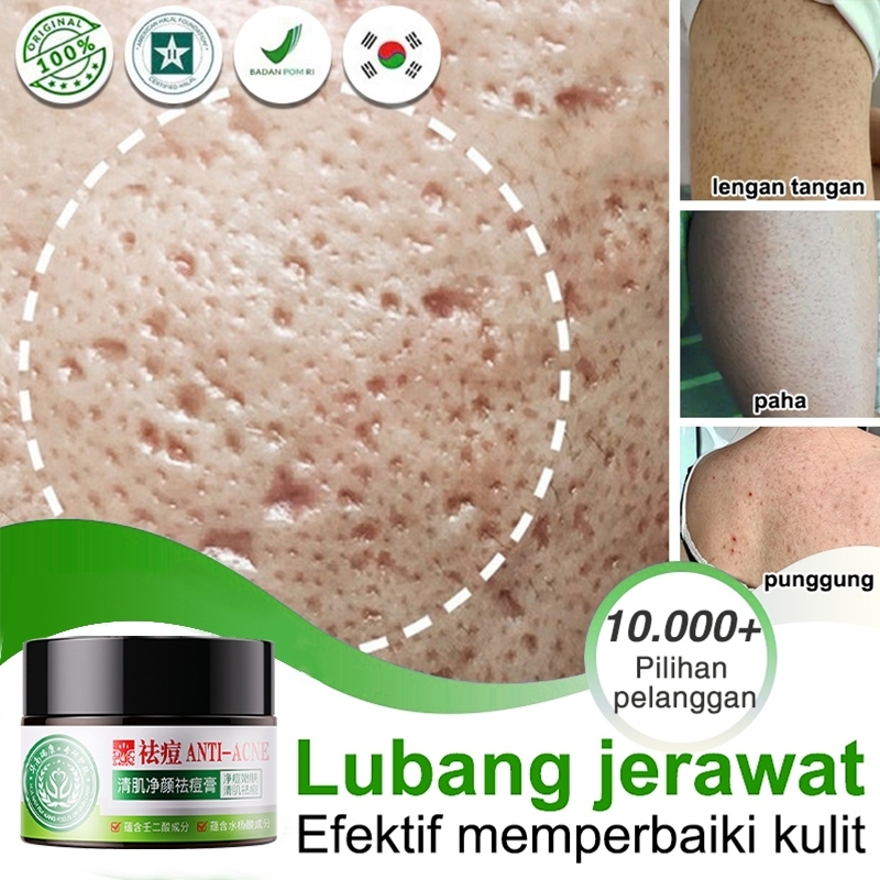 Penghilang Bekas Jerawat Krim jerawat Penghilang Bopeng Krim  mengecilkan pori pori wajah Obat jeraw