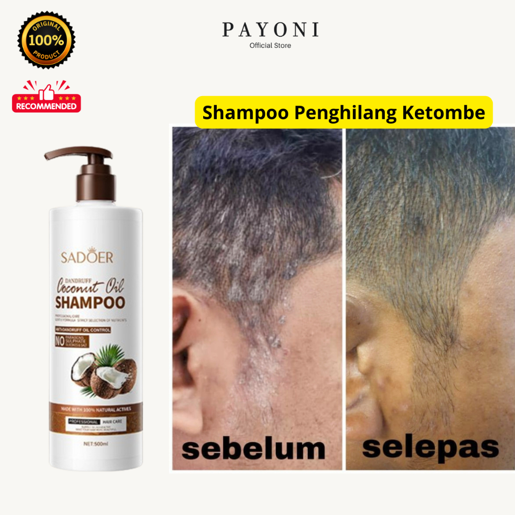 Shampo Ketombe dan Rontok Shampoo Ketombe Berkerak Psoriasis Sampo Ketomed