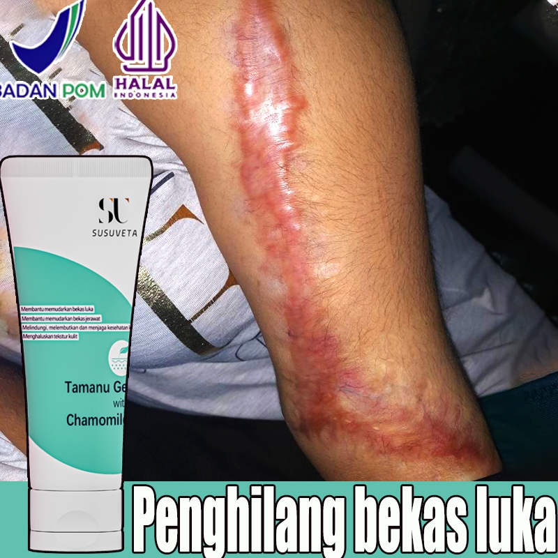 Penghilang bekas luka hitam koreng salep penghilang bekas luka obat penghilang bekas luka salep kelo