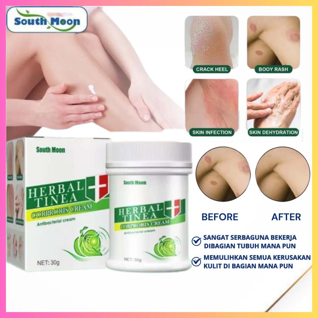 Salep Gatal Herbal, Iritasi Kemerahan, Psoriasis Pada Kulit Selangkangan, Kaki, Tangan, & Area Tubuh