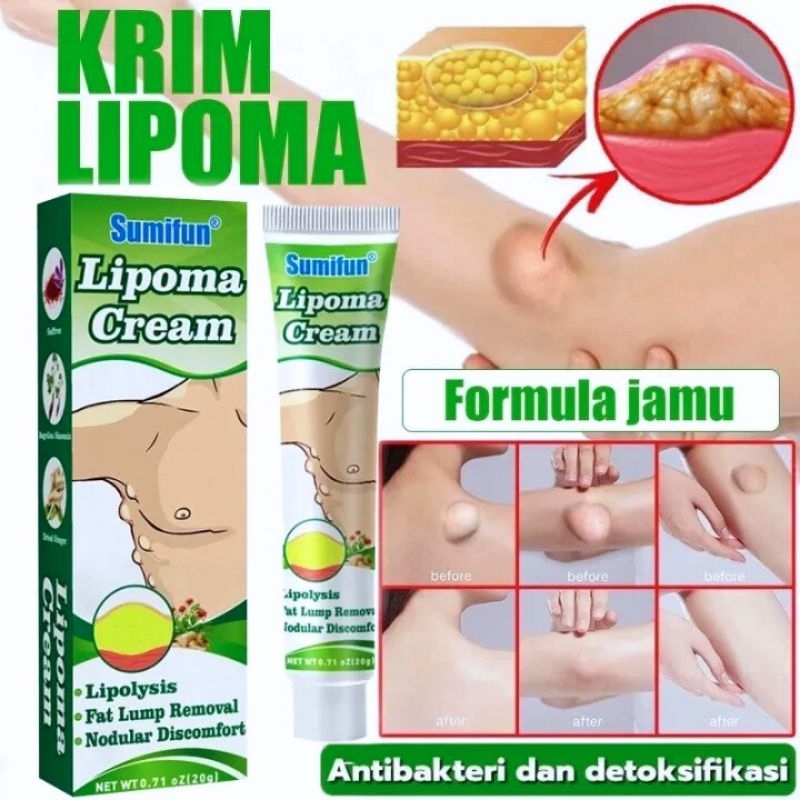 ORIGINAL SUMIFUN Lipoma Cream - Salep penghilang Benjolan di Ketiak Selangkangan Lipoma krim