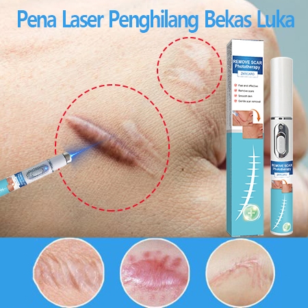 Penghilangan bekas luka bedah, penghilangan bekas luka, penghilangan bekas luka dengan pena laser,