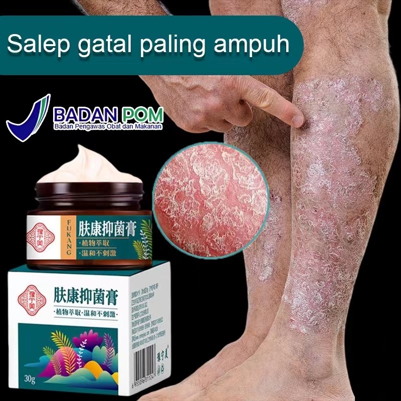 【100% Original】30G Salep gatal paling ampuh Obat psoriasis obat gatal salep kutil Obat Gatal Salep g