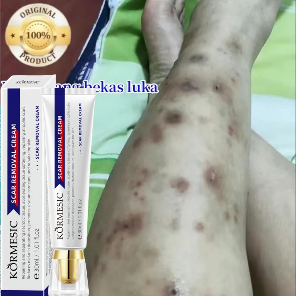 [ORI 100% ] Penghilang bekas luka Salep bekas luka Obat penghilang bekas luka Krim penghilang bekas 