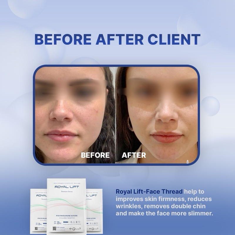 Royal Lift PDO/PCL Hiko Thread Lift, Nose Thread Lift Benang Hidung dan Wajah