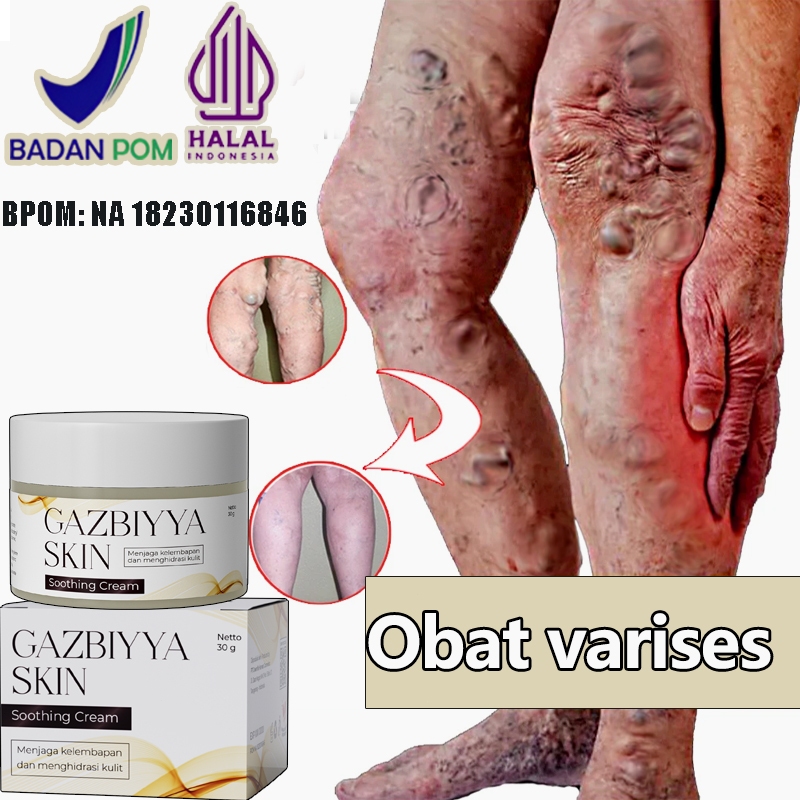 Obat varises salep varises paling ampuh salep varises obat varises kaki 20g cream varises paling amp