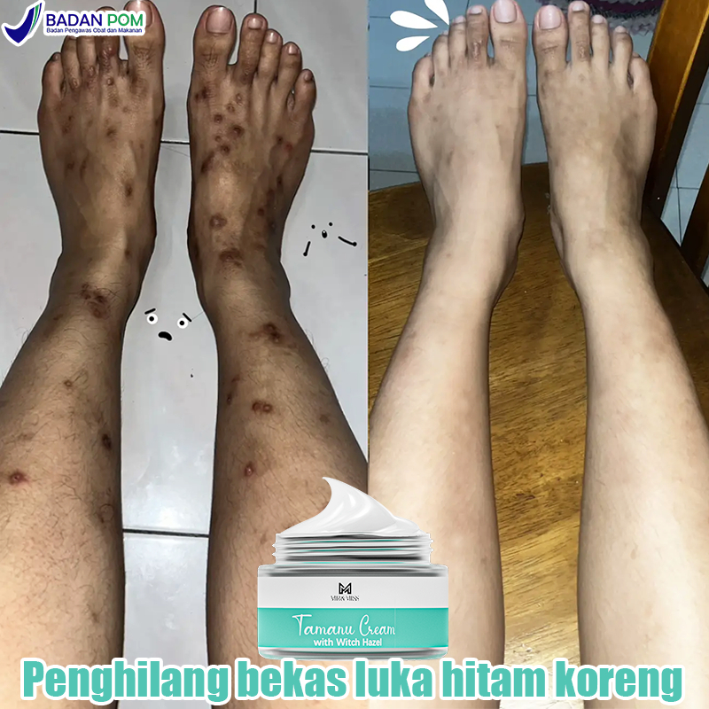 Salep penghilang bekas luka Obat penghilang bekas luka Salep penghilang bekas luka hitam Penghilang 