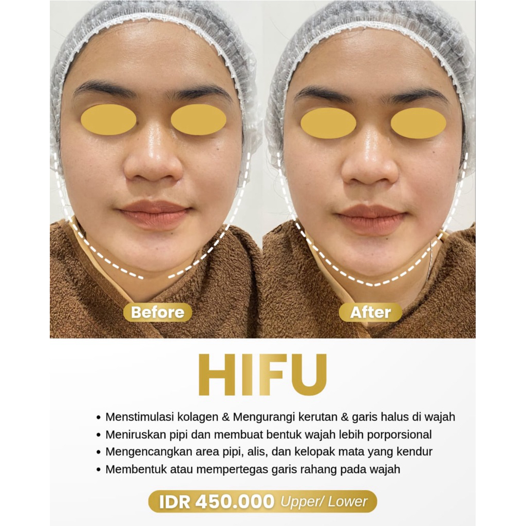hifu treatment (up and low)