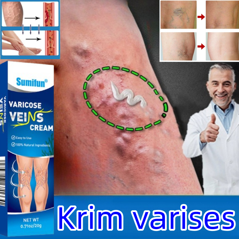 Obat Varises varicose veins cream salep varises salep varises paling ampuh penghilang varises di kak
