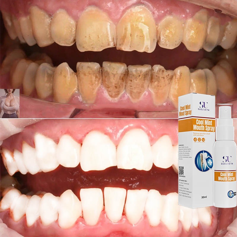 【BPOM】Perontok karang gigi paling ampuh Pembersih karang gigi berkerak karang gigi perontok 30ml pen