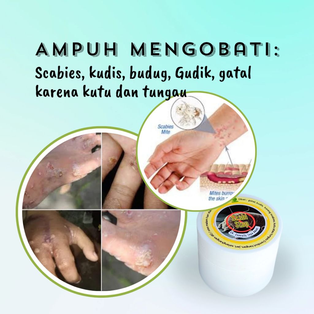Scabistop 28gr obat scabies, kudis, gudik, budug